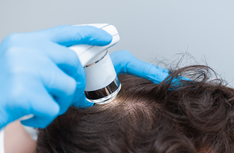 Psoríase capilar e queda de cabelo: tricologista com tricoscópio no couro cabeludo do paciente.