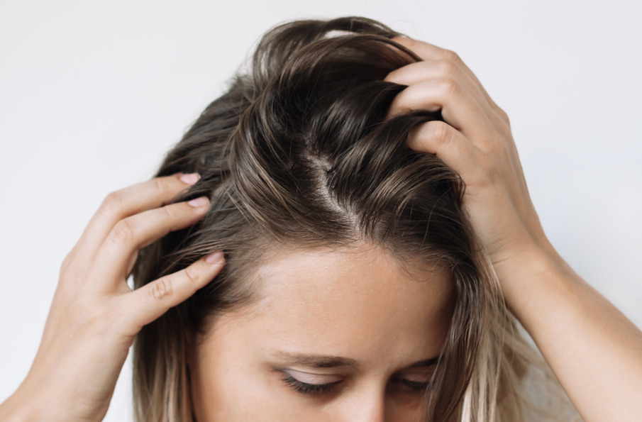 Seborreia no couro cabeludo: mulher passando a mão no cabelo oleoso.