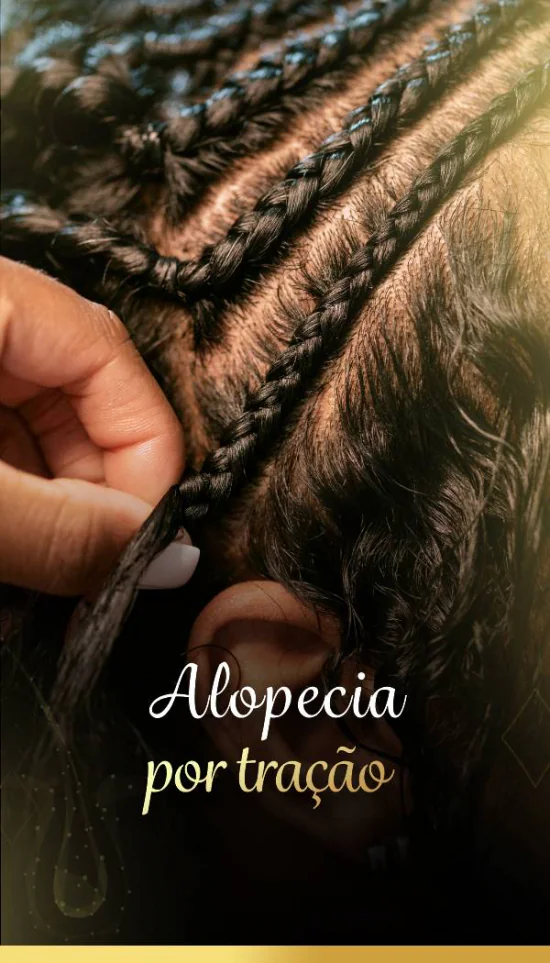 Alopecia por tracao