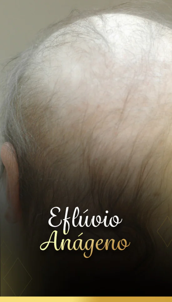 Efluvia anageno